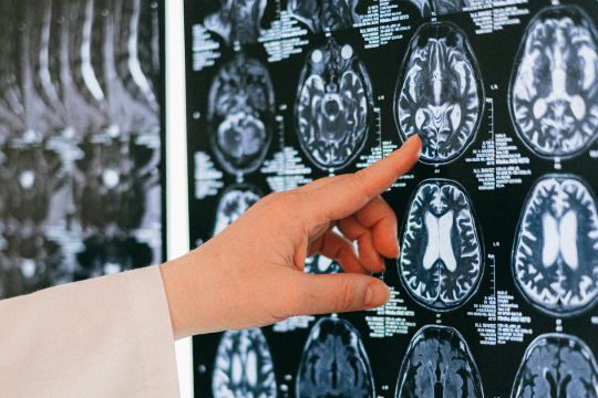 Building a Strong TAC Claim for Brain Injury Cases
